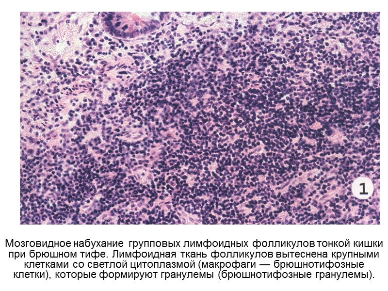Мозговидное набухание групповых лимфоидных фолликулов тонкой кишки при брюшном тифе. Лимфоидная ткань фолликулов вытеснена